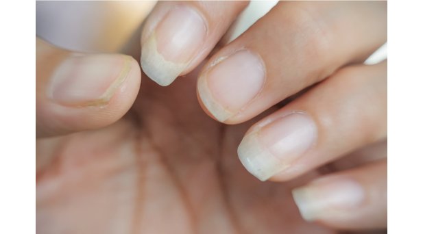 Unghie fragili che si sfaldano? Cosa fare per rinforzarle in estate