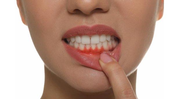 Gengive che sanguinano quando lavo i denti: ecco cause e rimedi