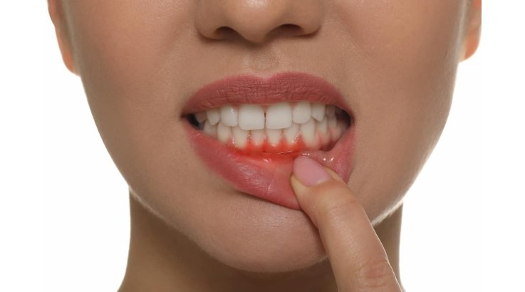 Gengive che sanguinano quando lavo i denti: ecco cause e rimedi