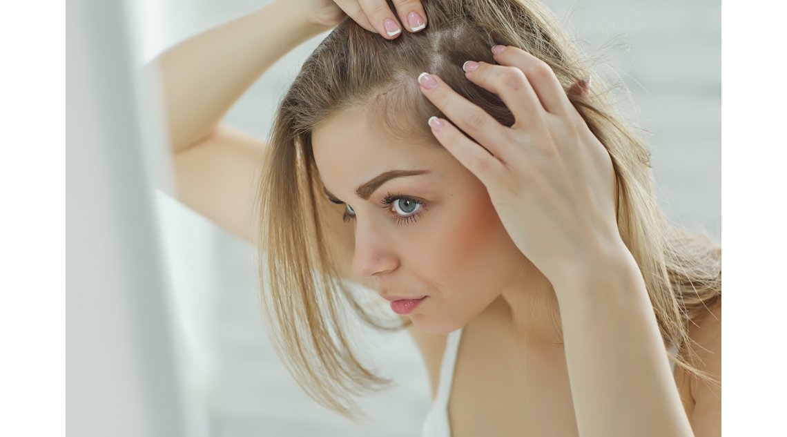 3 mosse per prevenire la psoriasi del cuoio capelluto