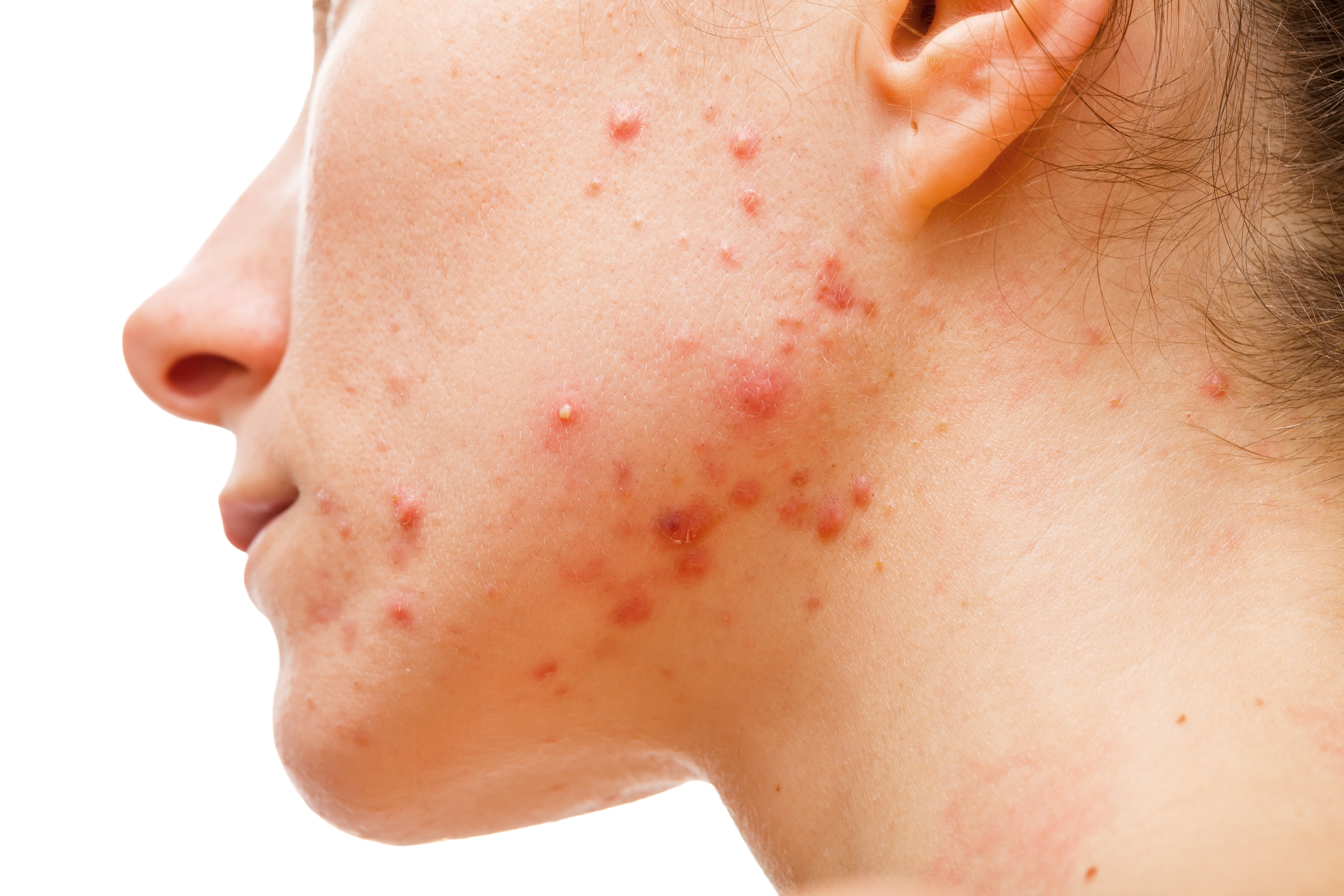 acne: cause e rimedi