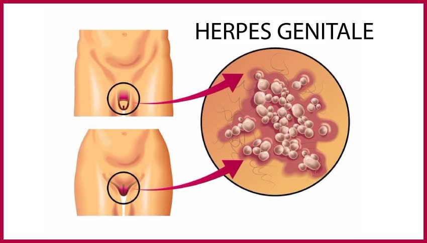 herpes genitale: cause e rimedi